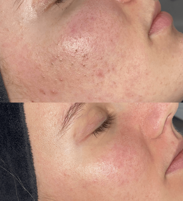 Avant après soin visage - Texture